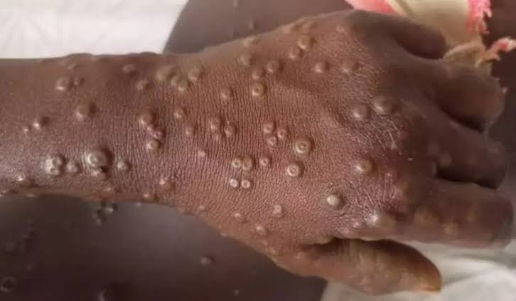 MoH Opens Up Homecare for MPOX As Cases Spiral